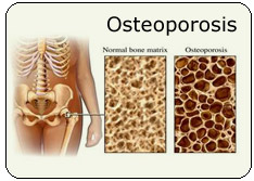 Click here for overview of course - OSTEOPOROSIS